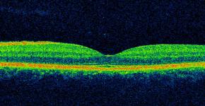 An OCT cross-sectional scan of the macula (central area of the retina)